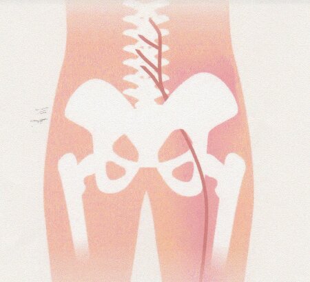 Išias - vzroki in simptomi