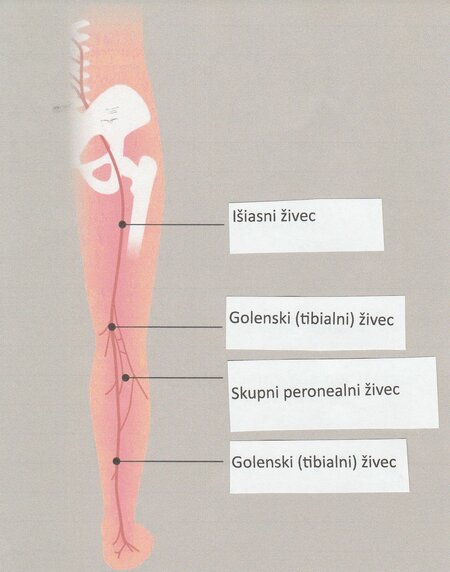 Išias - vzroki in simptomi